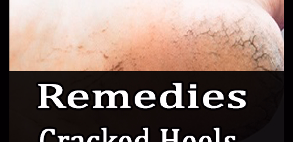 Remedies for cracked heels – e Header - AppWisp.com Remedies for cracked heels – e Header - AppWisp.com