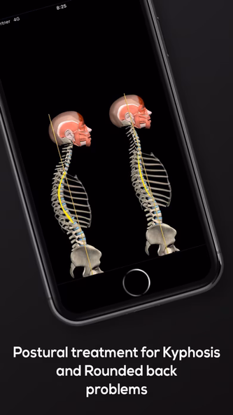 Kyphosis & Rounded Back Screenshot 4 - AppWisp.com Kyphosis & Rounded Back Screenshot 4 - AppWisp.com